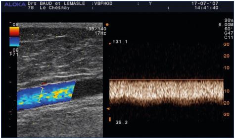 Replacement flux in the greater thigh saphenous vein after obliteration of the femoral vein The reflux is a spontaneous, permanent flux of 20 cm/second that is not modulated by breathing
