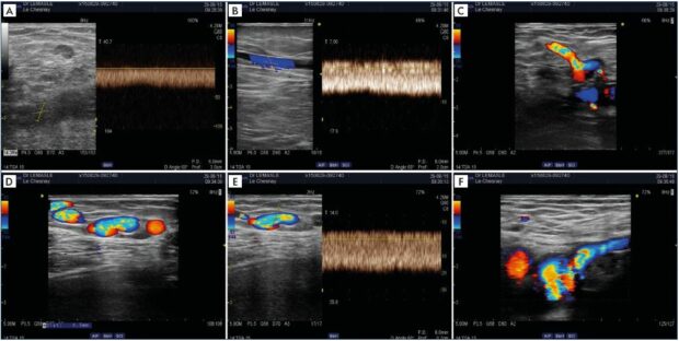 Postthrombotic left iliac venous obstruction and substitution syndrome