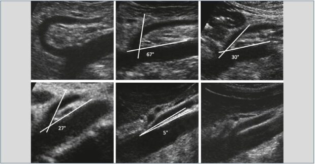 First step of the algorithm to determine whether the venous obliteration is obstructive.<br srcset=