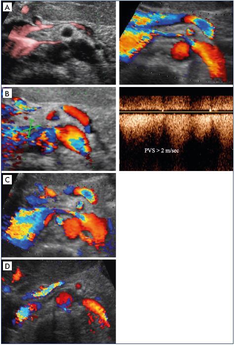 Second step of the algorithm to determine whether the venous obliteration is obstructive Search for direct ultrasound criteria of venous obliteration Panel