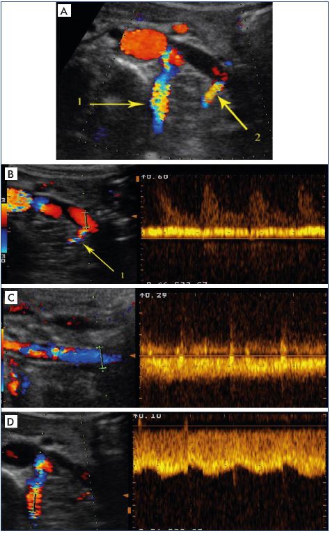 Third step of the algorithm to determine whether the venous obliteration is obstructive Search for indirect ultrasound criteria of venous obstruction