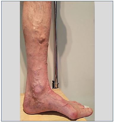 perforating veins insufficiency