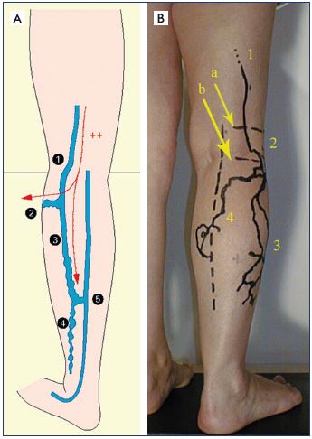 les varices causes