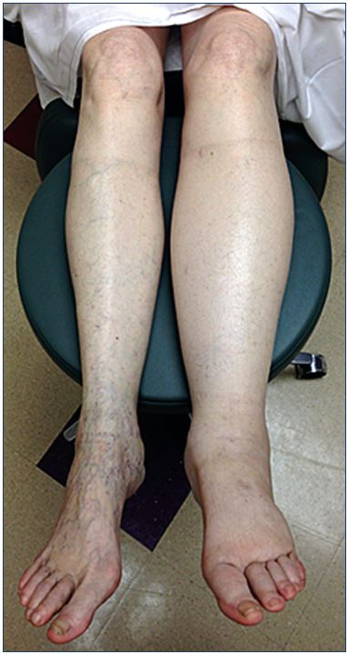 venous stasis edema of bilateral lower limb icd 10