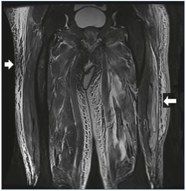 Pathophysiology of edema in patients with chronic venous