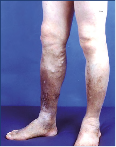 Venous stasis edema of bilateral lower limb icd 10. Muguri de mesteacăn pe vodcă pentru varice
