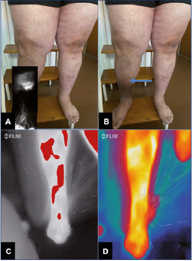 Chronic Venous Insufficiency (CVI), Department of Surgery