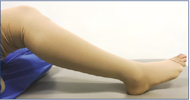 The Truth About Wearing Compression Stockings After Vein Treatment