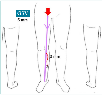 CLINICAL CASE 2. The natural history of varicose vein progression