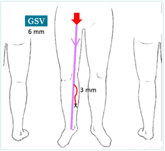 CLINICAL CASE 2. The natural history of varicose vein progression - Servier  - PhlebolymphologyServier – Phlebolymphology